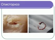лечение описторхоза