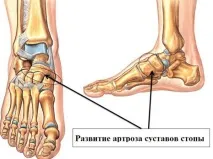 Про що говорять симптоми артрозу стопи та як його лікувати артрозу