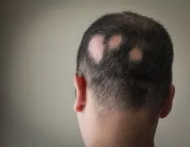 лечение фактори