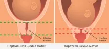 Окситоцин при пологах плюси та мінуси, наслідки для дитини плюси