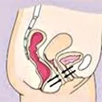 свиване мускулите vaginismus