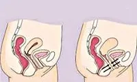 vaginismus докосване гениталиите