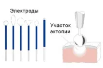 Виділення при ерозії шийки матки шийки