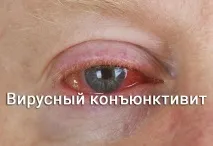 видове вирусен конюнктивит