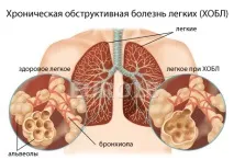 белодробна болест белодробна болест