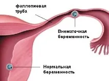 6 перших ознак позаматкової вагітності позаматкової