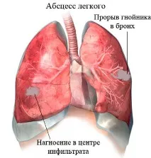 пневмония белодробен