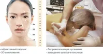 Фармакопунктура – плацентарні ін’єкції «Лаєньок» фармакопунктура