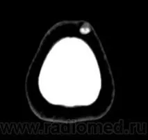 Онкологія. Пиломатриксома. Ріломатрічома. + пиломатриксома