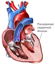 Кардіоміопатія серця
