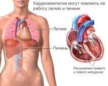 Кардіоміопатія може