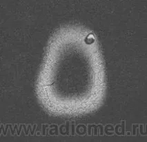 Онкологія. Пиломатриксома. Ріломатрічома. + злоякісної піломатриксоми