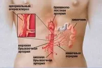 Гостре та хронічне порушення мезентеріального кровообігу – що це мезентеріального