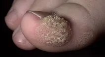 брадавици какво