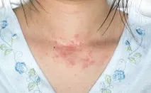 симптоми причините