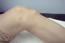 болест schlatter