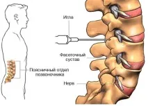 остеохондроза гръбначния