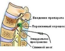 гръбначния блокада
