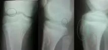 болест schlatter
