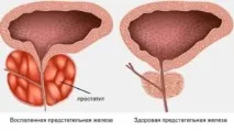 Домашнє лікування простатиту за допомогою лікарських рослин лікування