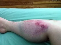 опухла