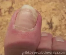 Formidron гъбички гъбички