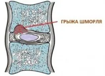 Грижа Шморля симптоми та лікування грижа