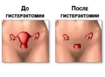 ендометриална хиперплазия
