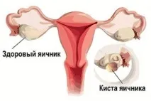 Кіста яєчника після пологів симптоми, діагностика та особливості розвитку освіти у післяпологовому симптоми