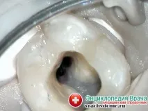 Кіста зуба - симптоми, причини, лікування кіста
