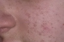комедони комедони