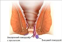 лечение хемороиди