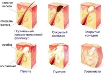 причини методи