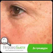 Fraxel