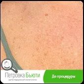 шкіри