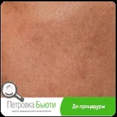 Fraxel