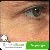 Fraxel