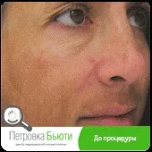 Fraxel