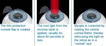 късогледство усещания