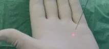 липосукция липосукция