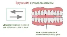 деца бруксизъм