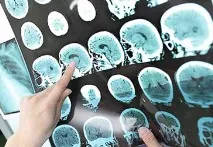 цереброспиналната течност neuromed