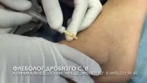 вени разширени