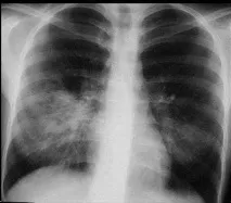 Ureaplasma urealyticum симптоми
