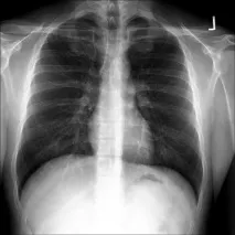 Міжреберна невралгія – як перемогти ворога, Meddesk невралгія
