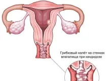 Молочниця без сверблячки, печіння та запаху молочниця