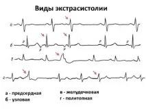 екстрасистоли подходи