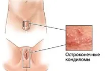 Гострокінцеві кондиломи причини, симптоми та лікування кондиломи