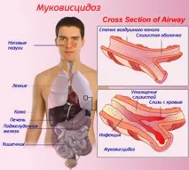 муковисцидоза