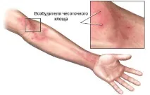 Підшкірні паразити симптоми, як позбутися паразити
